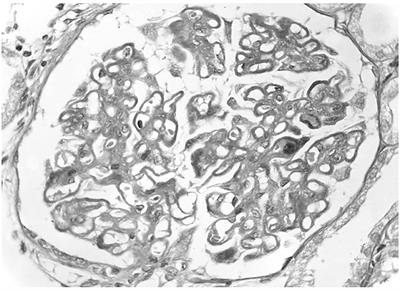 Secondary Membranous Nephropathy. A Narrative Review